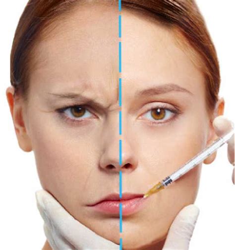 Aplicación de Botox Dr Sergio Burciaga Soto