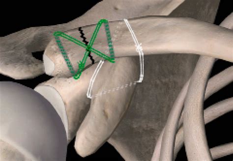 Coraco Clavicular Loop And Tension Band Suture In Type Ii And Type V