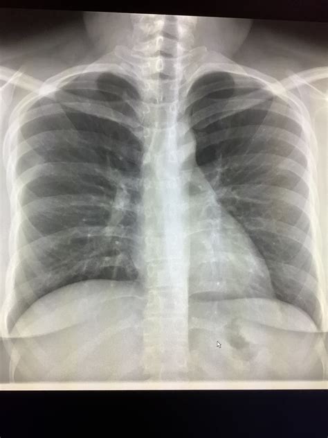 Hiatal Hernia On Chest X Ray Radiology In Plain English