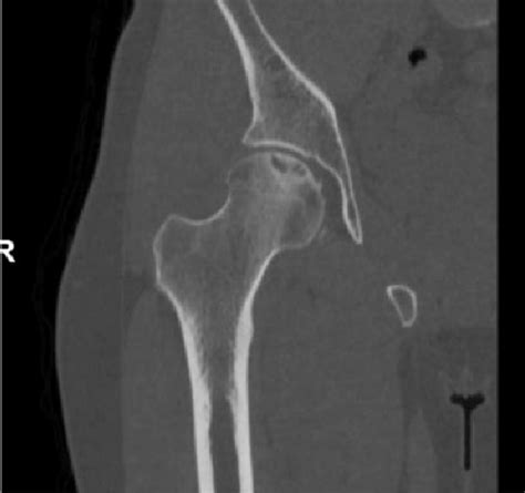 Computed tomography scan 20 months after injury demonstrates a ...