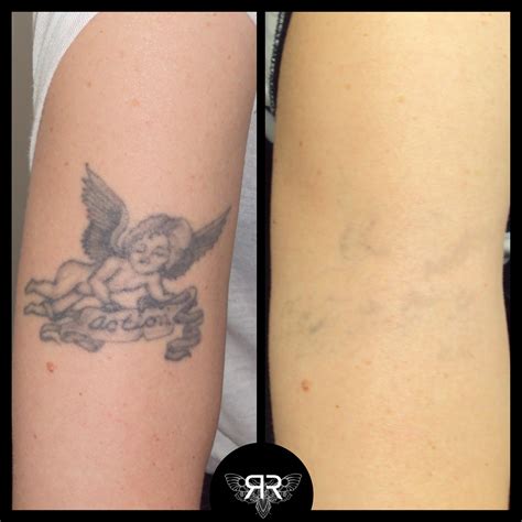 can tattoo removal leave scars 4