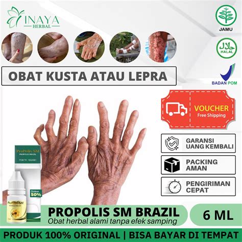 Jual Obat Herbal Penyakit Kusta Obat Kusta Lepra Obat Kusta Kering