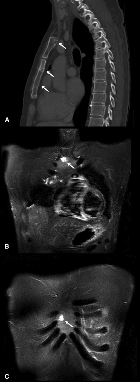 Robotic Mitral Valve Repair And Resection Of A Pericardial Cyst In