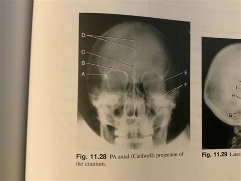 Skull Procedures Flashcards Quizlet