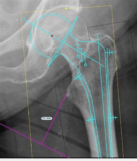 A patient who sustained a right femoral neck fracture was templated on ...