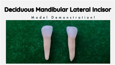 Deciduous Mandibular Lateral Incisor Tooth Morphology Youtube