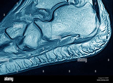 ENTHESOPATHY MRI Stock Photo - Alamy