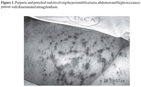 Scielo Brasil Cutaneous Periumbilical Purpura In Disseminated