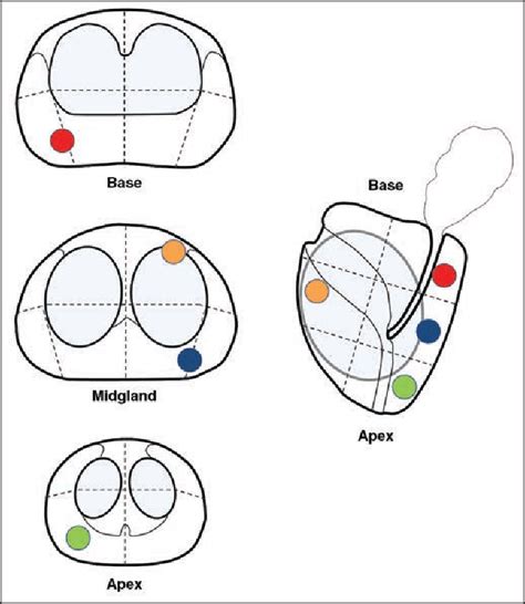 Figure 1 From Evaluation Of MRI TRUS Fusion Versus Cognitive