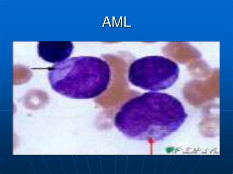 Ppt Hematological Malignancies Powerpoint Presentation Free Download Id 3814298