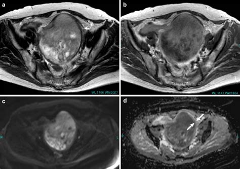 A D A Year Old Woman With Leiomyosarcoma Of The Myometrium A Axial