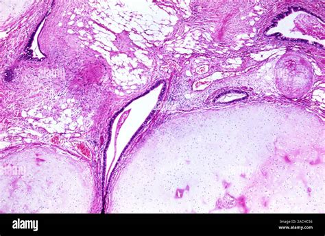 Testicular Cancer Light Micrograph Of A Section Through A