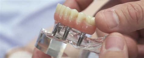 Full Mouth Dental Implants Cost In Mumbai India