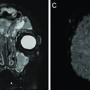 Preoperative Mri At The Time Of Presentation Sagittal T Weighted