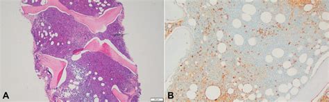 A Hypercellular Bone Marrow Core Biopsy ~70 Cellularity