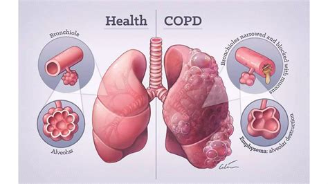 Obstructive Vs Restrictive Pulmonary Disease Pathology Atot Ppt