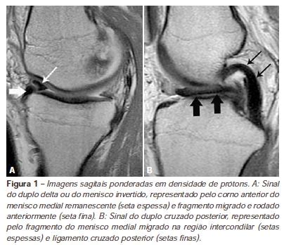 Scielo Brasil Rotura Em Al A De Balde Simult Nea Dos Meniscos No