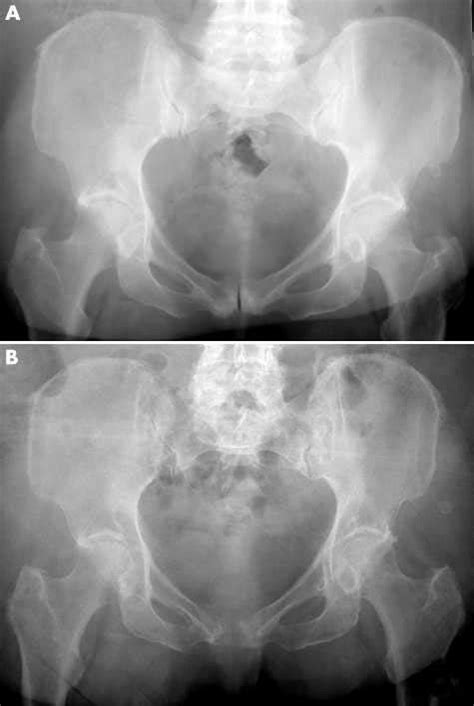 Radiographs Of The Symphysis Pubis A Early Degenerative