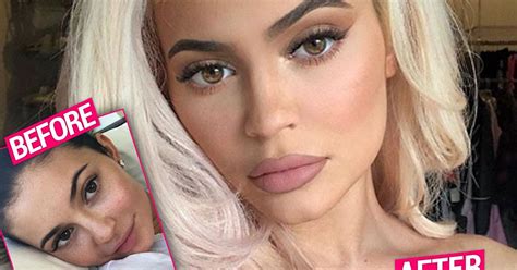 Kylie Jenner Gets Lip Fillers Back After Temporary Break