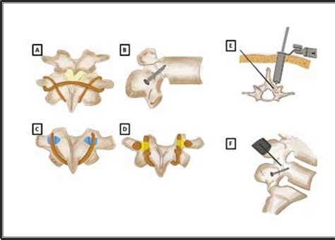 Figure 1 from Does Direct Surgical Repair Benefit Pars Interarticularis ...