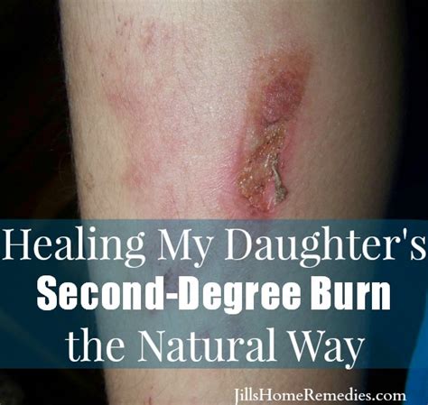 Healing My Daughter's Second-Degree Burn - Jill's Home Remedies