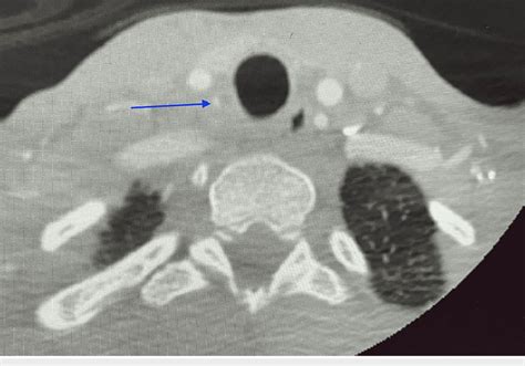 CT Angiogram Of The Head And Neck Showing Aberrant Right Vertebral