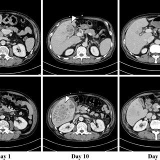 Enhanced Computed Tomography Scan Series Of Liver Abscess There Is