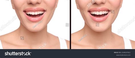 31 Laser Gingivectomy Images, Stock Photos & Vectors | Shutterstock