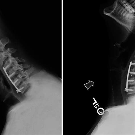 Preoperative Flexionextension Plain Films Download Scientific Diagram