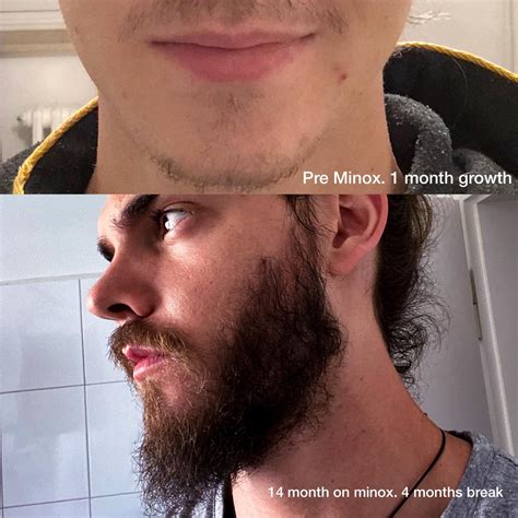 List 95 Pictures Minoxidil Beard Before And After Pictures Excellent