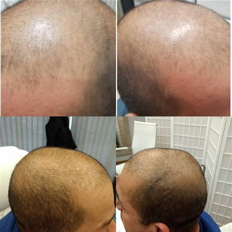 Prf Hair Restoration Services Drew Co Medical Aesthetics