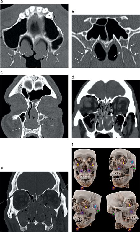 Facial Fractures The Bottom Up Approach Clinical Imaging