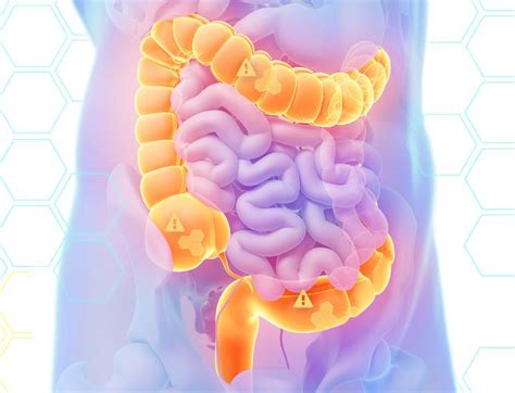 Mucus In Stool Colon Cancer