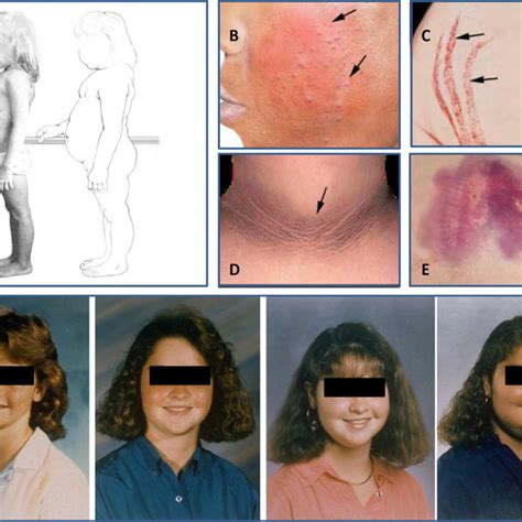 Top 105 Pictures Cushings Syndrome Cushings Disease Before And After