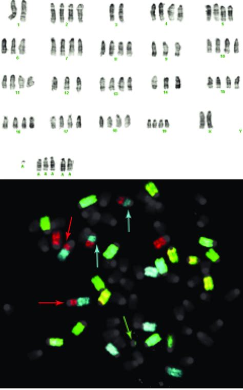 Karyotype Of A G Banded Metaphase Cell From A Tu 2449 Lesion Upper Download Scientific