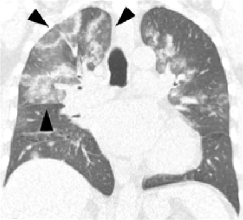 Covid 19 Pneumonia And The Reversed Halo Sign Originally Published In