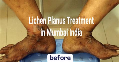 Effective Lichen Planus Treatment In Mumbai India Psoriatreat