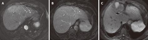 Liver Segments MRI