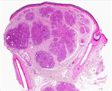 Photomicrograph Showing A Small Well Circumscribed Dermal Tumor With