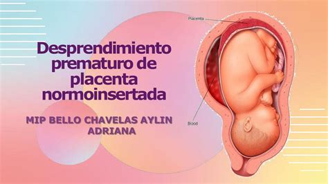 Desprendimiento Prematuro De Placenta Normoinsertada Arturo Diaz UDocz