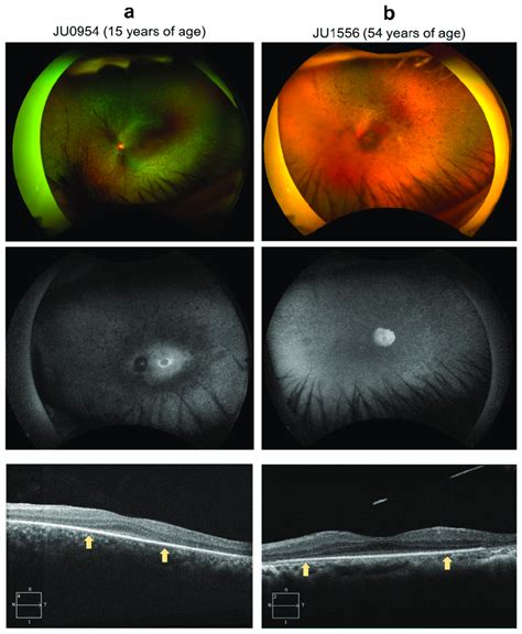 Color Fundus Photography Fundus Autofluorescence FAF And Optic