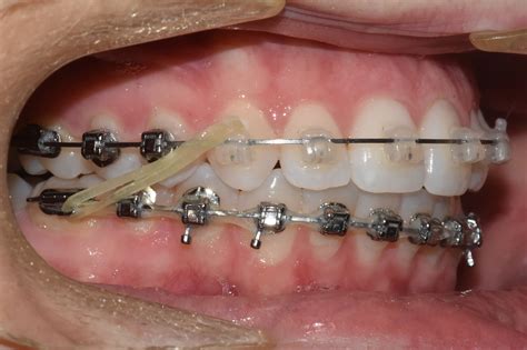 Elastics Bee Happy Orthodontics Bendigo