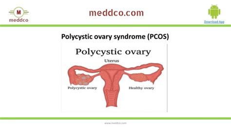 Ppt Polycystic Ovary Syndrome Pcos Powerpoint Presentation Free