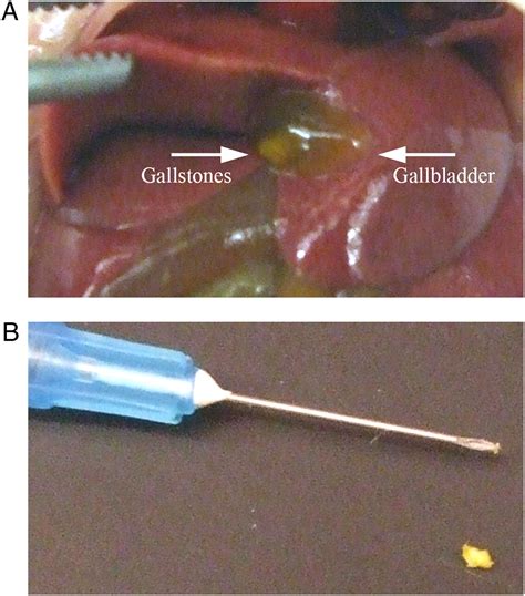 Cholesterol Gallstones In Stool