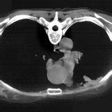 PDF The Pulmonary Physician In Critical Care Illustrative Case 7