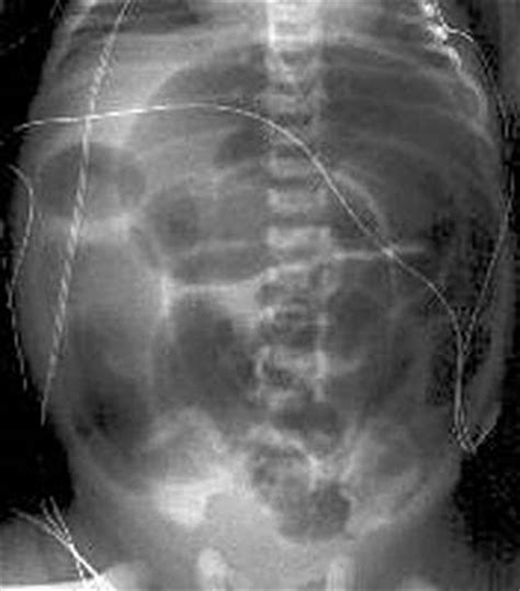 Meconium plug syndrome - wikidoc