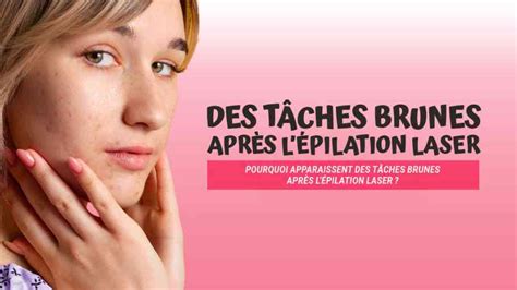 Les Avis Sur L Pilation Du Visage Au Laser Tnt Review