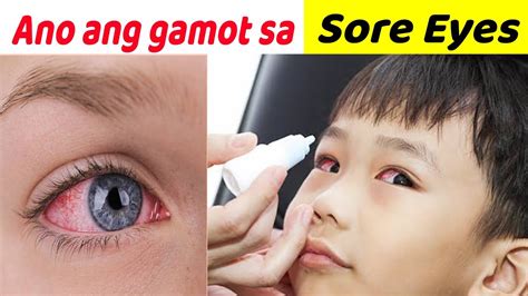 Paano Mawala Ang Sore Eyes Gamot Sa Sore Eyes YouTube