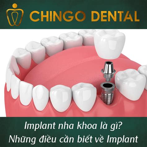 Implant nha khoa là gì Những điều cần biết về Implant 2021 Nha Khoa