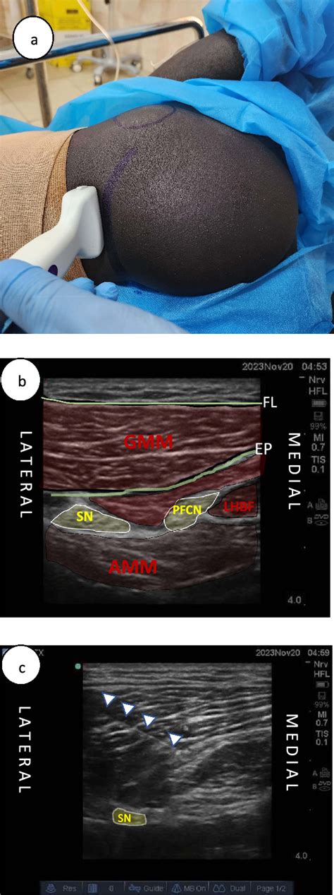 Pdf Combined Supra Inguinal Fascia Iliaca Sciatic Nerve And Posterior Femoral Cutaneous